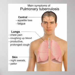 Main Symptoms of Pulmonary Tuberculosis Chart