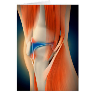 Medical Illustration: Inflammation In Knee