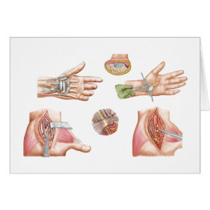 Medical Illustration Showing Carpal Tunnel