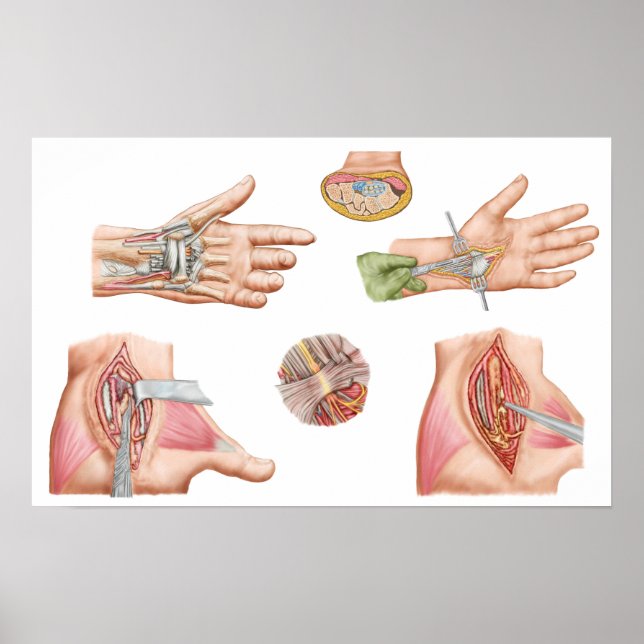 Medical Illustration Showing Carpal Tunnel Poster (Front)