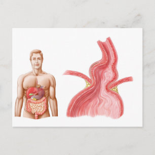 Medical Ilustration Of A Hiatal Hernia In The Postcard