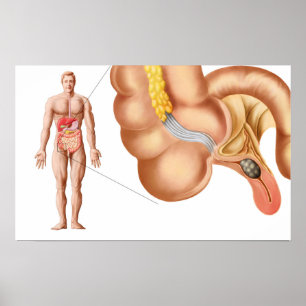 Medical Ilustration Of An Appendix Poster