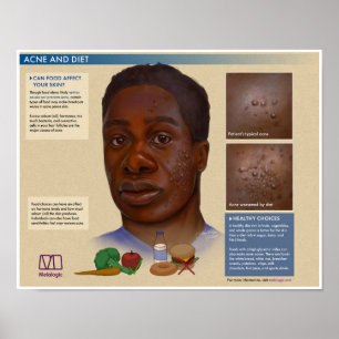 Melalogic Acne and Diet Medical Poster
