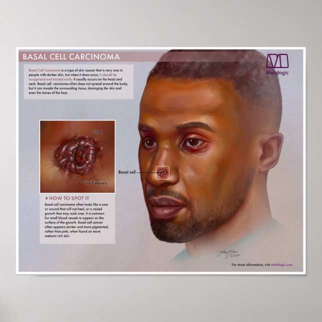 Melalogic Basal Cell Carcinoma Medical Poster (Front)