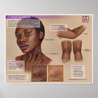 Melalogic Eczema Medical Poster