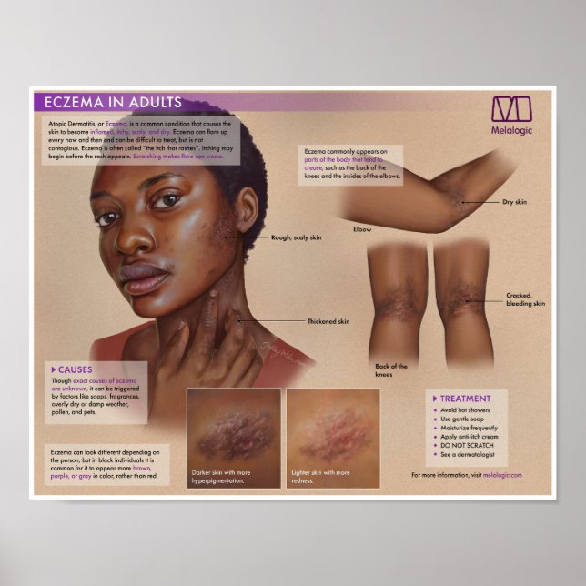 Melalogic Eczema Medical Poster (Front)