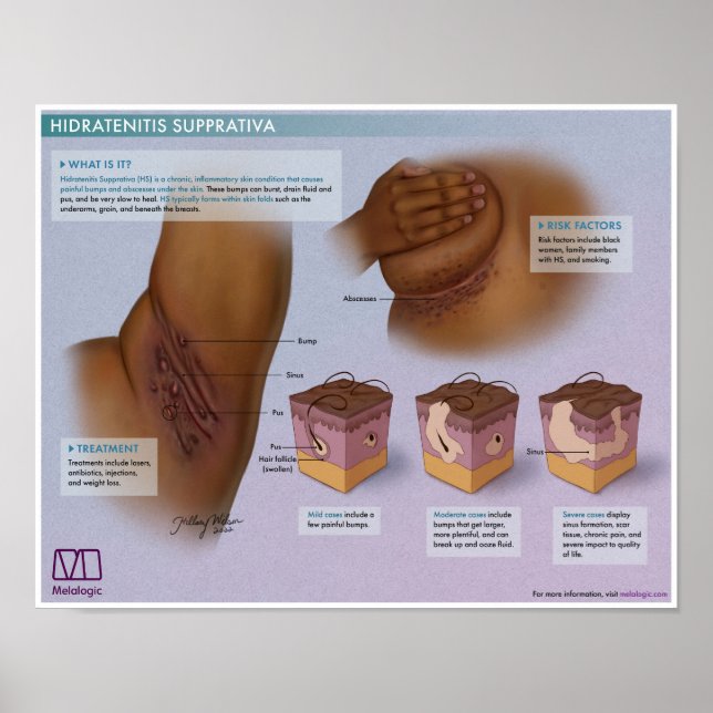 Melalogic Hidradenitis Supprativa Medical Poster (Front)
