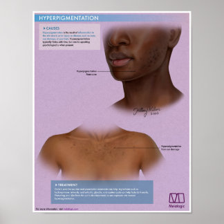 Melalogic Hyperpigmentation Medical Poster