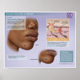 Melalogic Popping Pimples Medical Poster