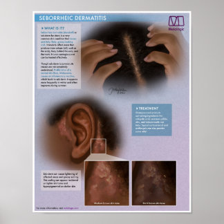 Melalogic Seborrheic Dermatitis (Dandruff) Medical Poster