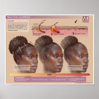Melalogic Traction Alopecia Medical Poster