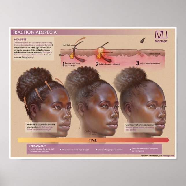 Melalogic Traction Alopecia Medical Poster (Front)