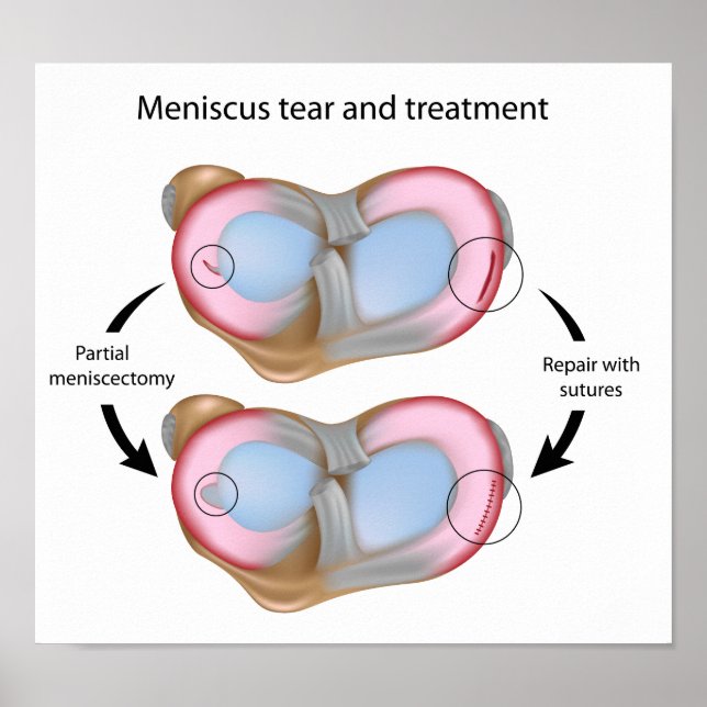 Meniscus tear and surgery  Poster (Front)