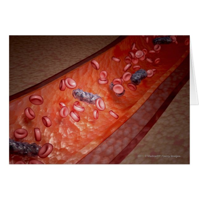 Microscopic rendering of a blood infection (Front Horizontal)