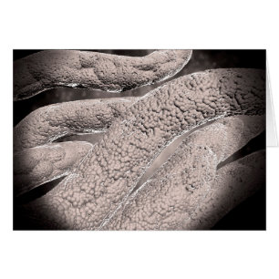 Microscopic View Of Corncob Formation