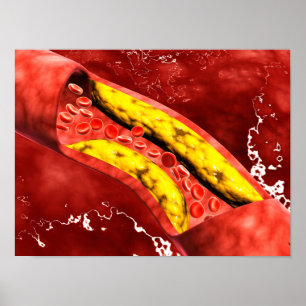 Microscopic View Of Fat Plaque Inside The Artery Poster