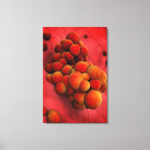 Microscopic View Of Tumour 2 Canvas Print