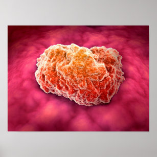 Microscopic View Of Tumour 3 Poster
