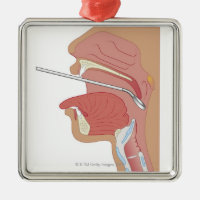 Mirror Laryngoscopy