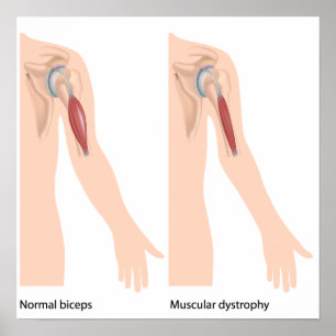 Muscular dystrophy Poster