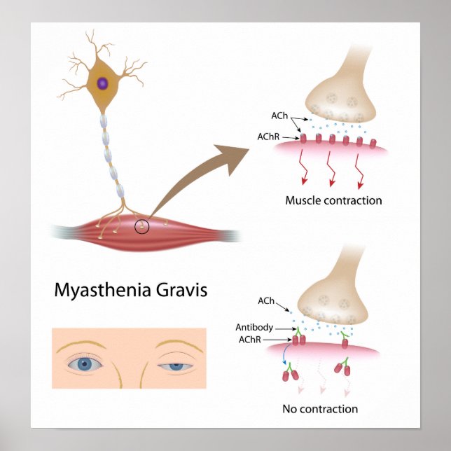 Myasthenia Gravis eye Poster (Front)