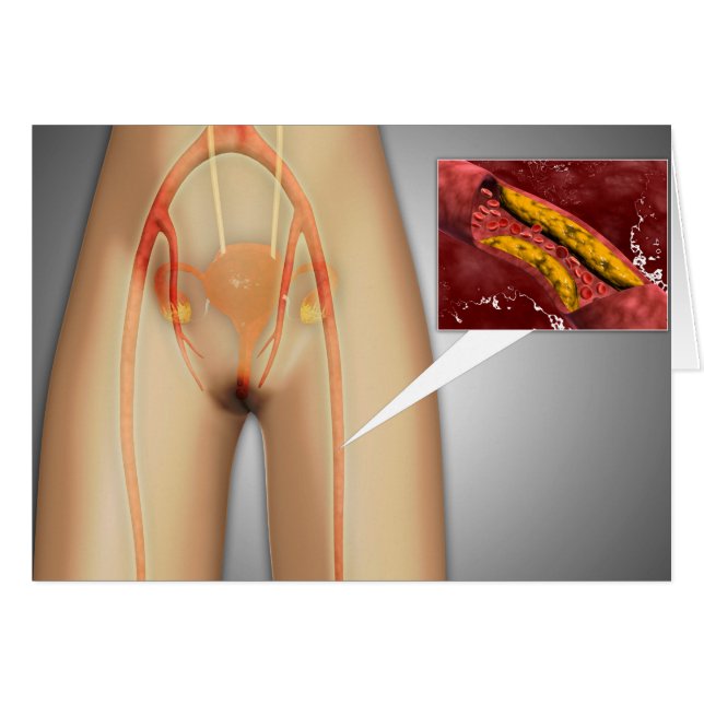 Narrowed Artery Near Leg Close-up (Front Horizontal)
