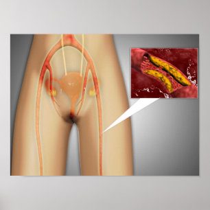 Narrowed Artery Near Leg Close-up Poster