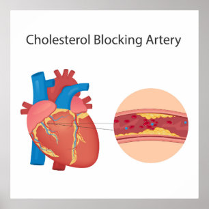 Narrowed blood vessels poster