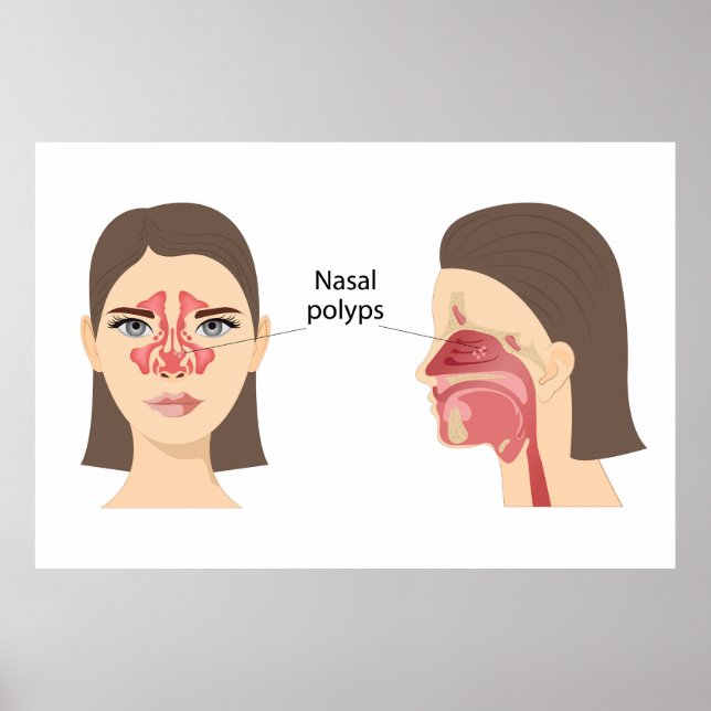  Nasal polyps Poster (Front)