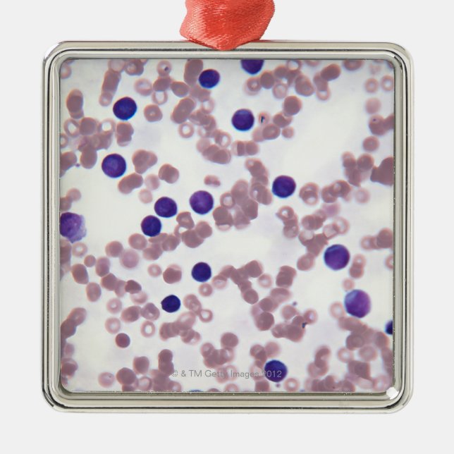 Neoplastic Lymphocyte Cells Metal Tree Decoration (Front)