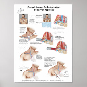 Netter Chart: Central Venous Catheterisation Poster
