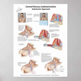 Netter Chart: Central Venous Catheterisation Poster