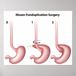 Nissen Fundoplication stomach Surgery  Poster