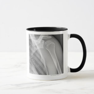 Normal shoulder. X-ray of the healthy left Mug