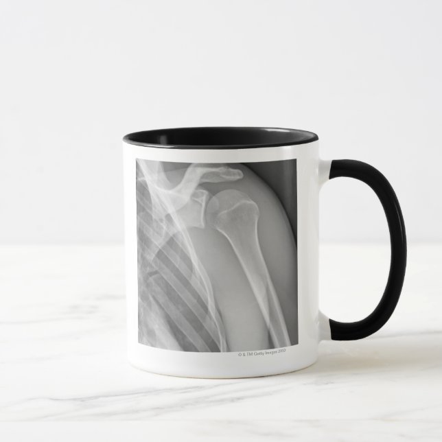 Normal shoulder. X-ray of the healthy left Mug (Right)