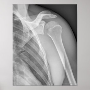 Normal shoulder. X-ray of the healthy left Poster