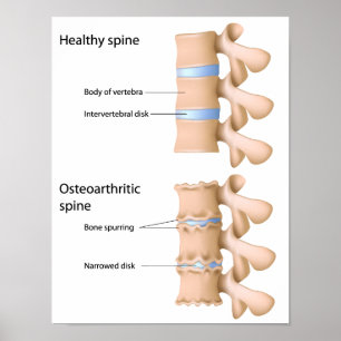 Osteoarthritis of the spine Poster