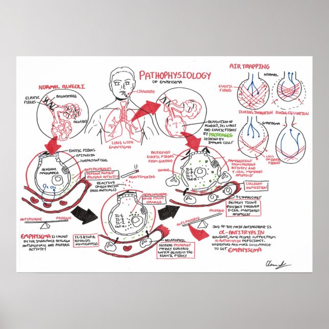 Pathophysiology of Emphysema Poster (Front)