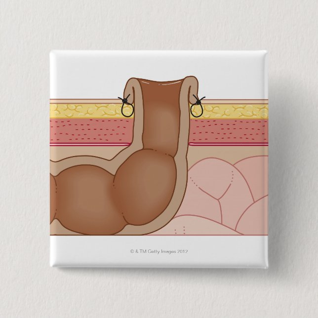 Permanent Colostomy 15 Cm Square Badge (Front)