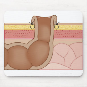 Permanent Colostomy Mouse Pad