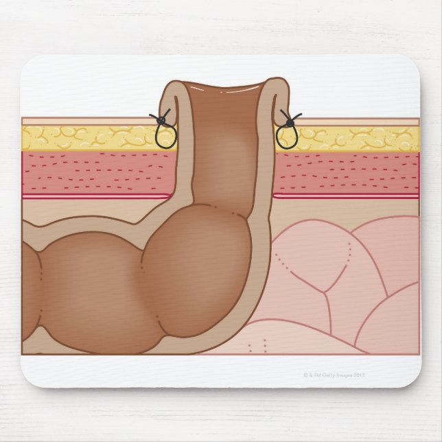 Permanent Colostomy Mouse Pad (Front)