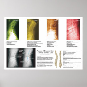 Phases Lumbar Spinal Degeneration Poster