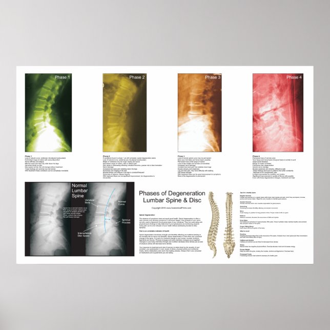 Phases Lumbar Spinal Degeneration Poster (Front)