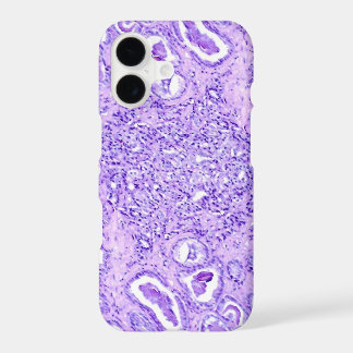 Phone Case(many models)-Prostate Cancer Cells