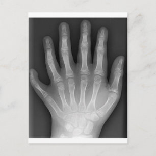 Polydactyly, Six Fingered Hand, X-Ray, rarity! Postcard