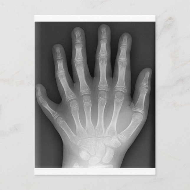 Polydactyly, Six Fingered Hand, X-Ray, rarity! Postcard (Front)