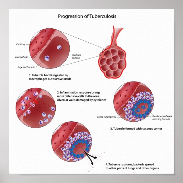 Progression of pulmonary tuberculosis Poster (Front)