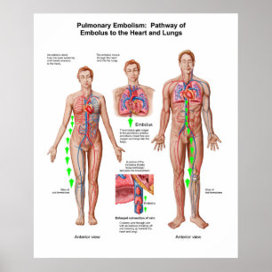 Pulmonary Embolism, Pathway Of Embolus Poster