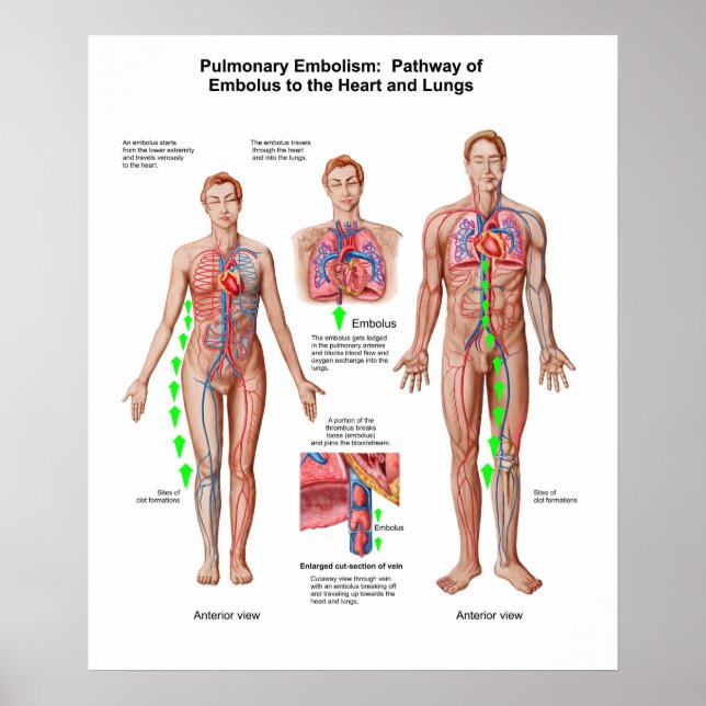 Pulmonary Embolism, Pathway Of Embolus Poster (Front)