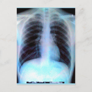 Ribcage Xray Skeleton Postcard